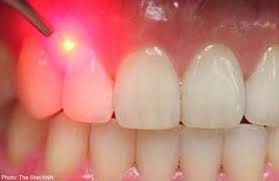 https://spanish.lifeboat.com/blog.images/researchers-use-light-to-coax-stem-cells-to-regenerate-teeth.jpg